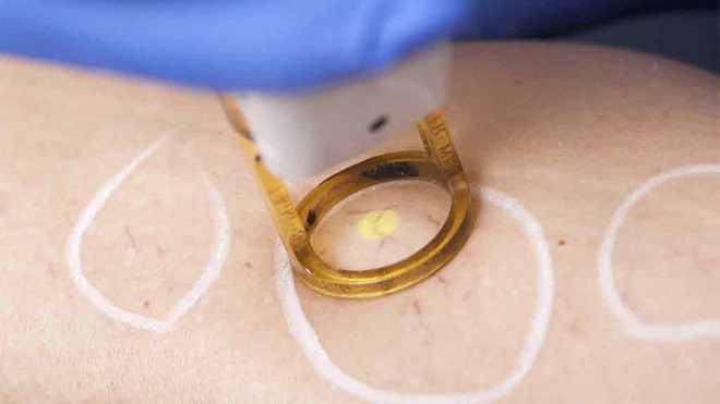 varicose vein laser treatment